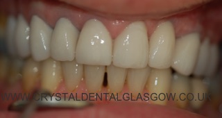 Implant crown and porcelain veneers in place