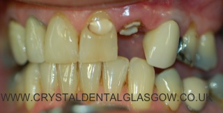 dental implant images before