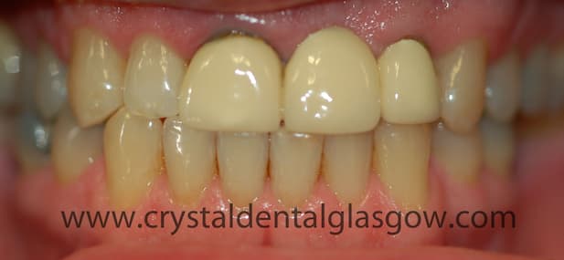 After this infected root was removed the patient received two mini dental implants