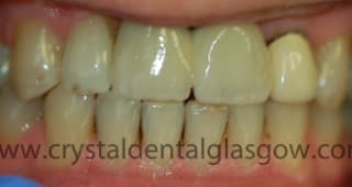 Twominidentalimplants