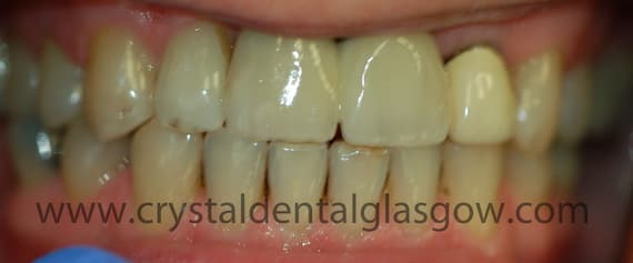 Two mini implants on implant crowns