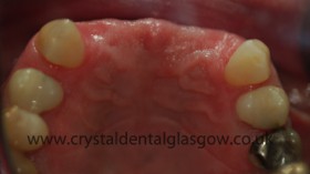 dental implant porcelain case study 2