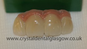 dental implant porcelain case study 1