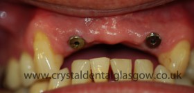dental implant porcelain case study 4
