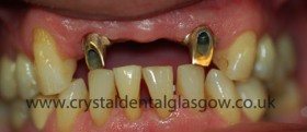 dental implant porcelain case study 5