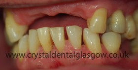 dental implant porcelain case study 3