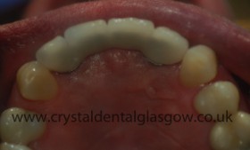 dental implant porcelain case study 6