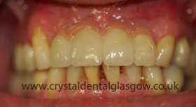 dental implant porcelain case study 7