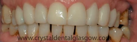 porcelain veneers