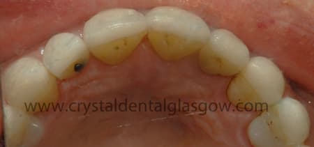 porcelain veneers from below
