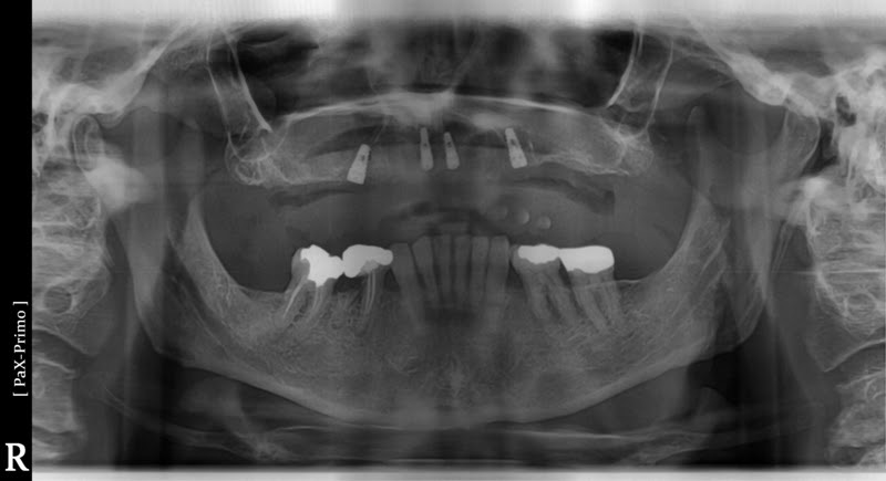 All on four implant x-ray