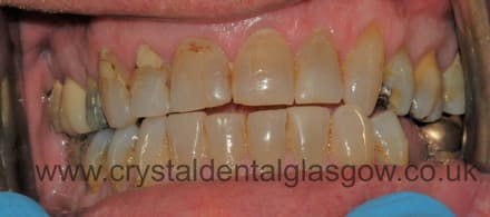 Jim from Partick before his Cosmetic Dentistry