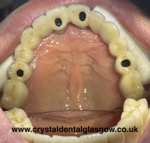 All on 4 Implant from below