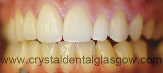 After Cosmetic braces and tooth whitening