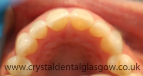 6 month smiles example after