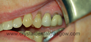 One Dental Implant with Porcelain Bonded to Gold Crown after