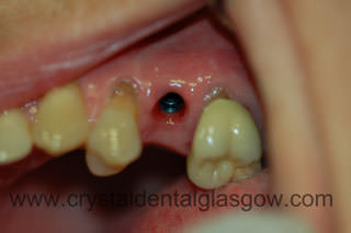 One Dental Implant with Porcelain Bonded to Gold Crown before