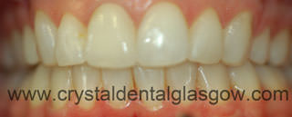 after clear braces fitted