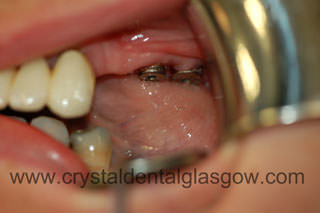 dental implants before