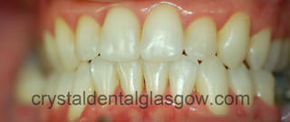 after orthodontic treatment