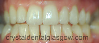 Clear Braces Dental Images after