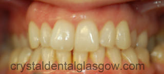 Clear Braces Dental Images before