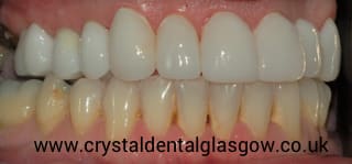 cosmetic dentistry patient in glasgow 1