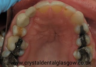 cosmetic dentistry patient in glasgow 2