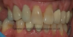 old NHS porcelain crown needed to go