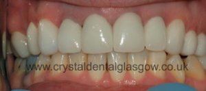 front view of composite fillings