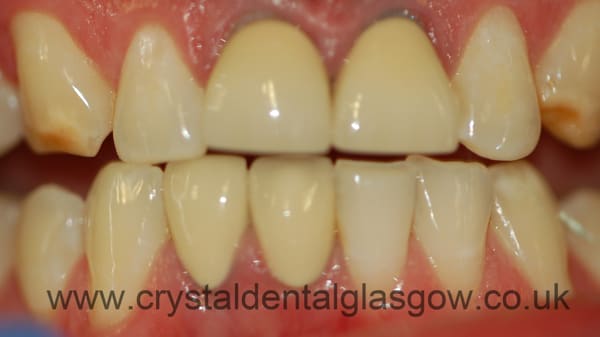 cosmetic crowns case study 1