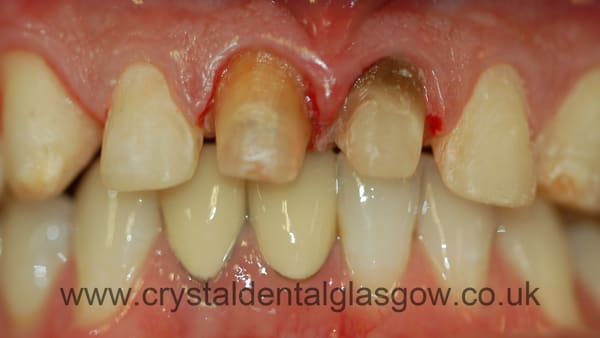 cosmetic crowns case study 1