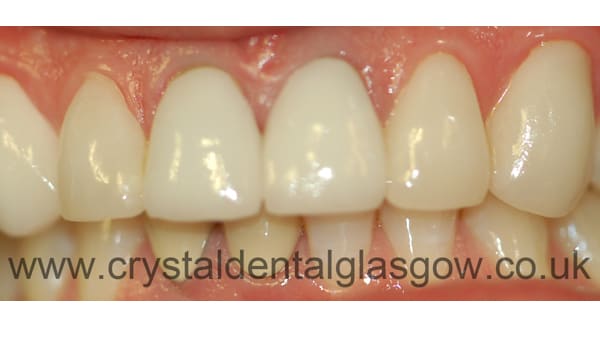 cosmetic crowns case study 3