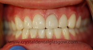 After composite bonding cosmetic dentistry case 5