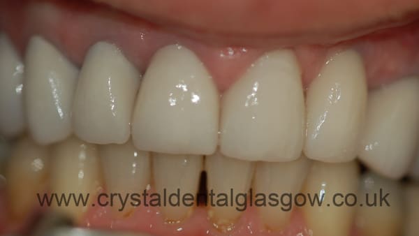 Same patient after implant work