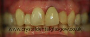 Replacing Old Porcelain Crowns 1