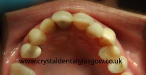 Replacing Old Porcelain Crowns 2