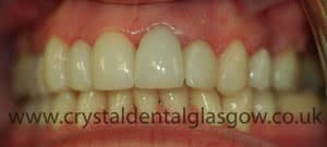 Replacing Old Porcelain Crowns 3