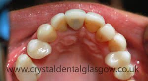 Replacing Old Porcelain Crowns 4