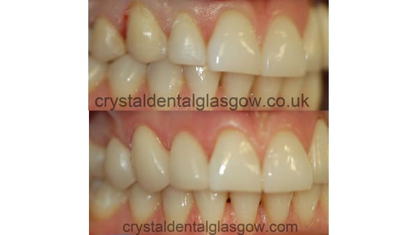 samedayveneers same day veneers