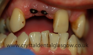zirc before