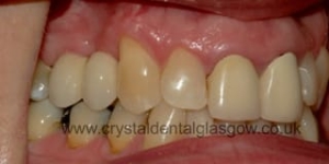 Fitting the dental implant option