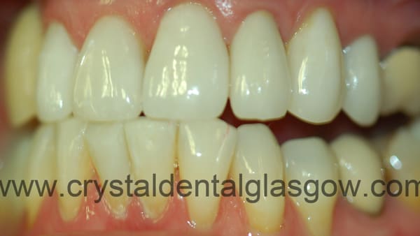 3 metal-free crowns after