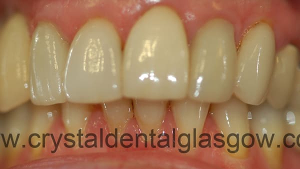 3-metal-free-crowns-before 3 metal-free crowns before