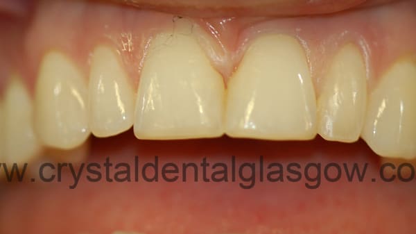 6-metal-free-crowns-before 6 metal free crowns before