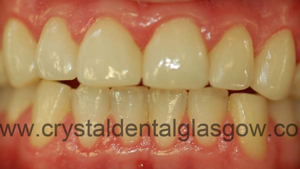 6-porcelain-veneers-after 6 porcelain veneers after