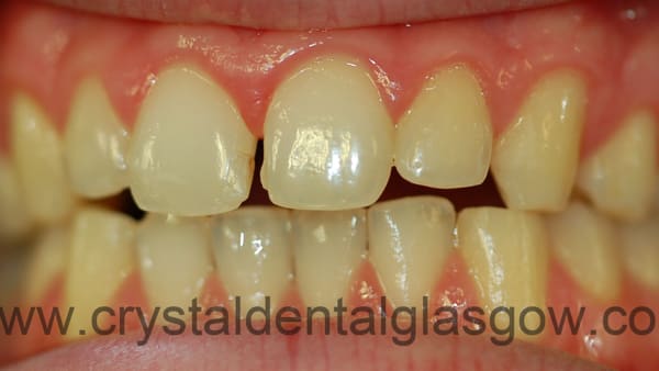 6-porcelain-veneers-before 6 porcelain veneers before