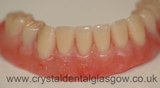 lower denture