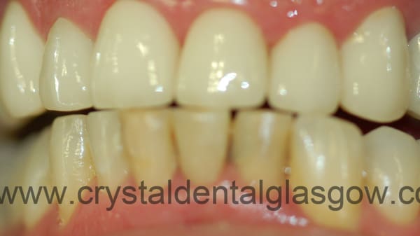 8 metal free crowns after