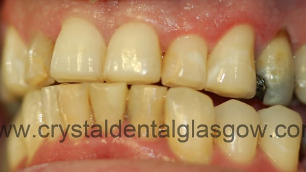 8-metal-free-crowns-before 8 metal free crowns before